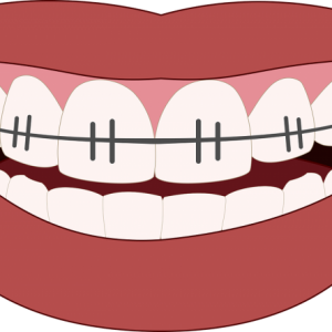 orthodontics-3109763_1280