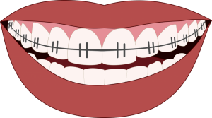 orthodontics-3109763_1280